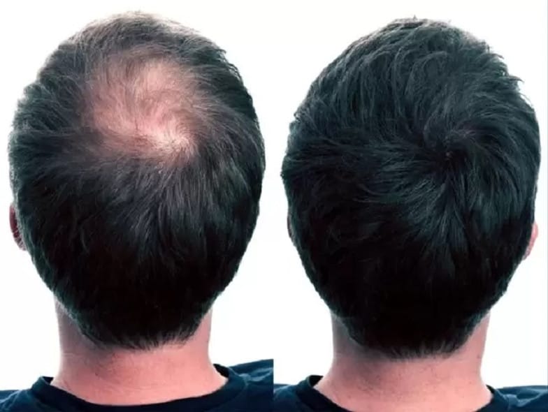 Imported King-yes Instant Hair Thickener Spray 30ml Black & Brown